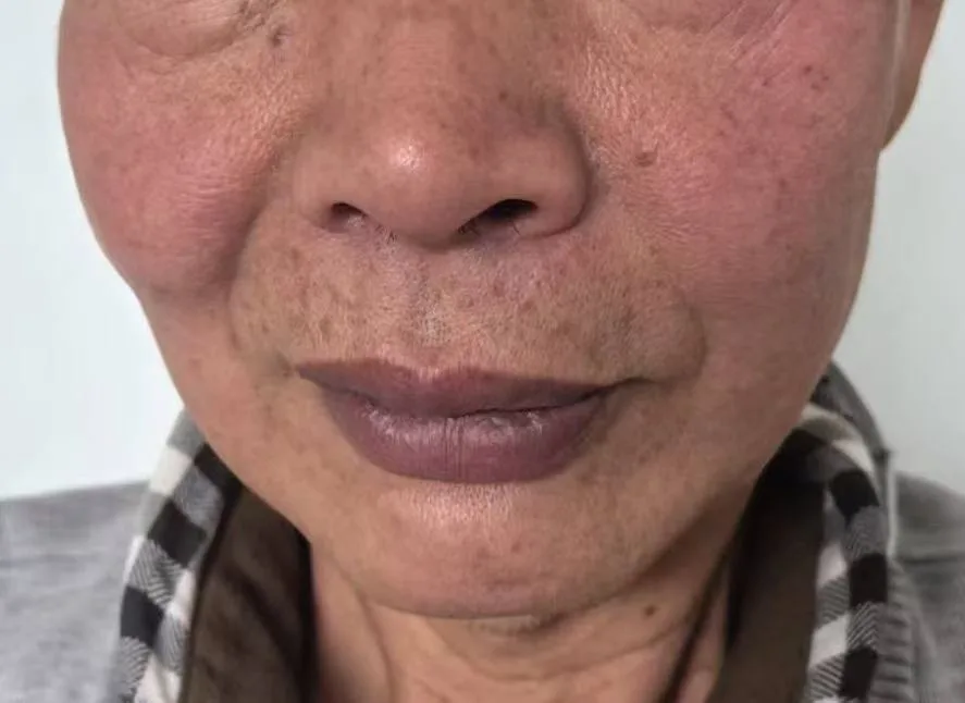 脸红像醉酒酒驾检测却为零！温州大叔一查，竟是罕见血液病